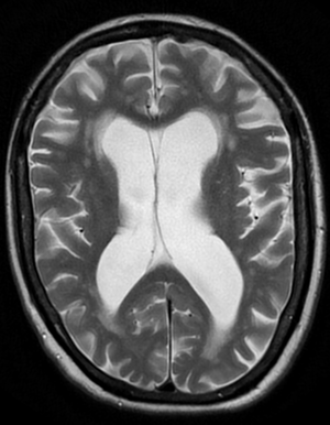 BrainAtrophy(exvacuo).png