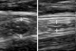 A normal appendix without and with compression. Absence of compressibility indicates appendicitis.[45]