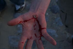 An open bleeding wound on the palm caused by falling from a skateboard
