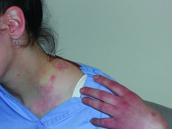 Pustule in generalized vaccinia