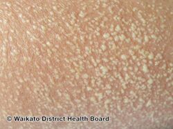 Acute generalized exanthematous pustulosis - many small spread out pustules