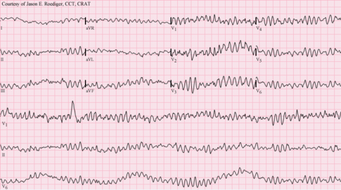 The arrhythmia, ventricular fibrillation, seen on an ECG