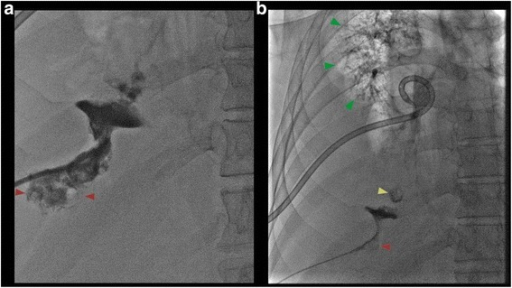 a) Fluoroscopic view shows contrast in collapsed liver abscess red arrow b) fluoroscopic view shows contrast tracking from the liver abscess red arrow