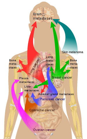 Metastasis sites for common cancers.svg