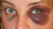 Black eye 2.jpg