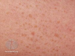 Ichthyosis acquisita