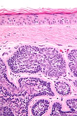 Micrograph of dermal cylindroma in H&E stain.