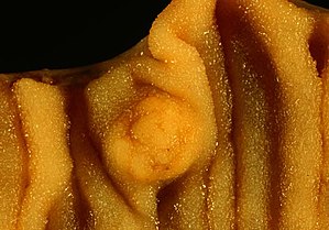 Multiple Carcinoid Tumors of the Small Bowel 2.jpg