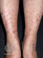 Guttate psoriasis