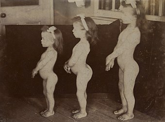 Three sisters with achondroplasia Wellcome L0061377.jpg