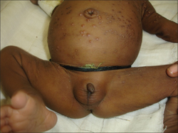 Multiple, grouped and discrete vesicles on the underarms