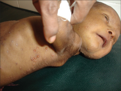 Multiple, grouped and discrete vesicles on the abdomen