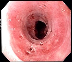 Esophageal intramural pseudodiverticulosis.jpg