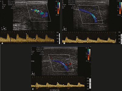 Longitudinal, ventral ultrasound of the penis, with pulsed mode and color Doppler. Flow of the cavernous arteries at 5, 15, and 25 min after prostaglandin injection (A, B, and C, respectively). The cavernous artery flow remains below the expected levels (at least 25–35 cm/s), which indicates ED due to arterial insufficiency.[39]