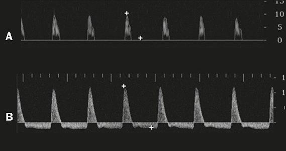 Graphs representing the color Doppler spectrum of the flow pattern of the cavernous arteries during the erection phases. A: Single-phase flow with minimal or absent diastole when the penis is flaccid. B: Increased systolic flow and reverse diastole 25 min after injection of prostaglandin.[39]