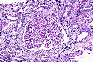 Acute Interstitial Nephritis.jpg