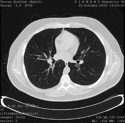 CT Scan General Illustration.jpg