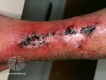 Necrotising fasciitis (DermNet NZ bacterial-nec-fas5).jpg