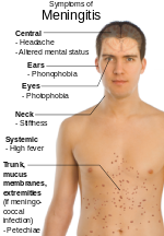 Symptoms of Meningitis.svg
