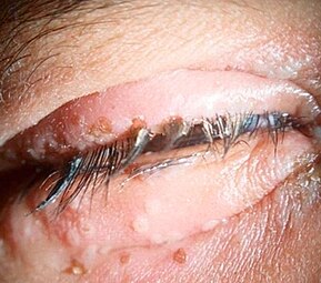herpetic blepharitis