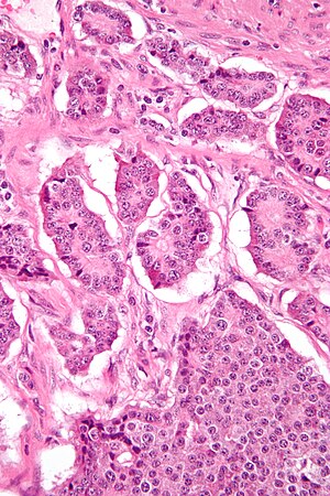 Small intestine neuroendocrine tumour high mag.jpg