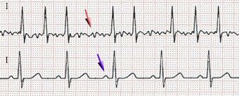 Electrocardiographic image depicting atrial fibrillation