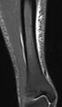 Shinsplint-mri (crop).jpg