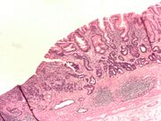 Adenocarcinoma of the stomach and intestinal metaplasia. H&E stain.
