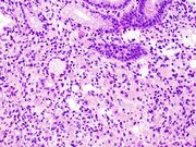 Gastric signet ring cell carcinoma. H&E stain.