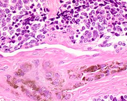 A high power of melanotic neuroectodermal tumor of infancy showing pigmented large epithelioid cells and smaller primitive cells (hematoxylin and eosin stain).