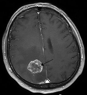 Brain metastasis in the right cerebral hemisphere from lung cancer shown on T1-weighted magnetic resonance imaging with intravenous contrast.