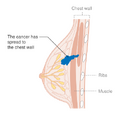 Stage 3B breast cancer