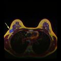 MRI showing breast cancer