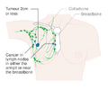 Stage 2A breast cancer