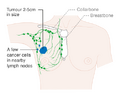 Stage 2B breast cancer
