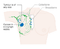 Stage 3A breast cancer
