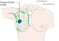 Stage 2A breast cancer