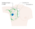 Stage 3B breast cancer