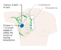 Stage 2B breast cancer