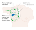 Stage 3A breast cancer