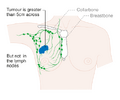 Stage 2B breast cancer