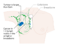Stage 3A breast cancer