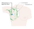 Stage 1A breast cancer