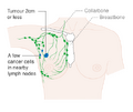 Stage 1B breast cancer