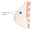 Stage T1 breast cancer