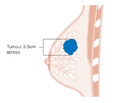 Stage T2 breast cancer