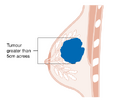Stage T3 breast cancer