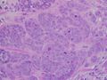 High-grade invasive ductal carcinoma, with minimal tubule formation, marked pleomorphism, and prominent mitoses, 40x field