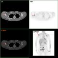 F-18 FDG PET/CT: A breast cancer metastasis to the right scapula