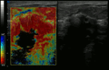 Elastography shows stiff cancer tissue on ultrasound imaging.